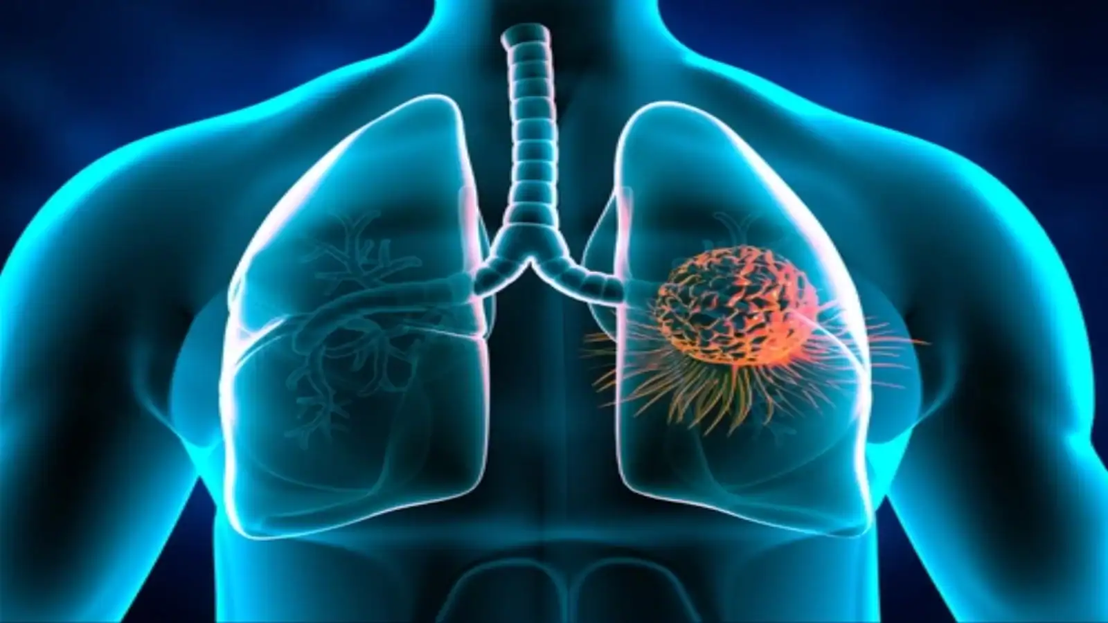 Cancerul pulmonar, descoperit prea târziu în România. Medicul Cristian Oancea cere introducerea screeningului național